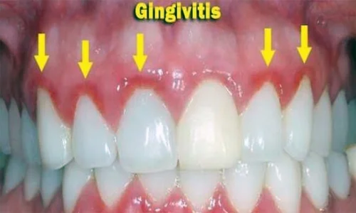gingivitis y periodontitis