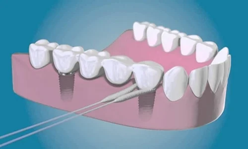 informacion implantes dentales higiene bucal