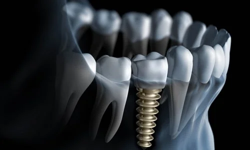informacion implantes dentales