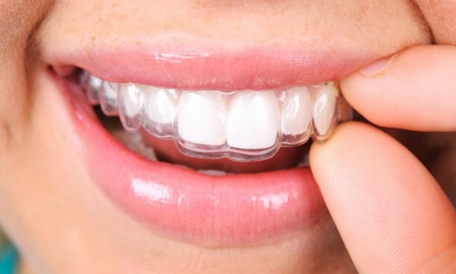 tratamiento de blanqueamiento dental en casa Ferula para blanqueamiento dental en casa