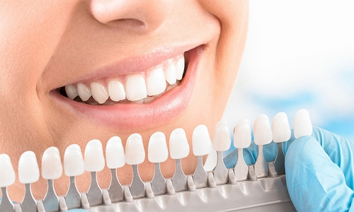 Dientes Blancos gracias al tratamiento de blanqueamiento dental Clínica para blanqueamiento dental en Navalcarnero